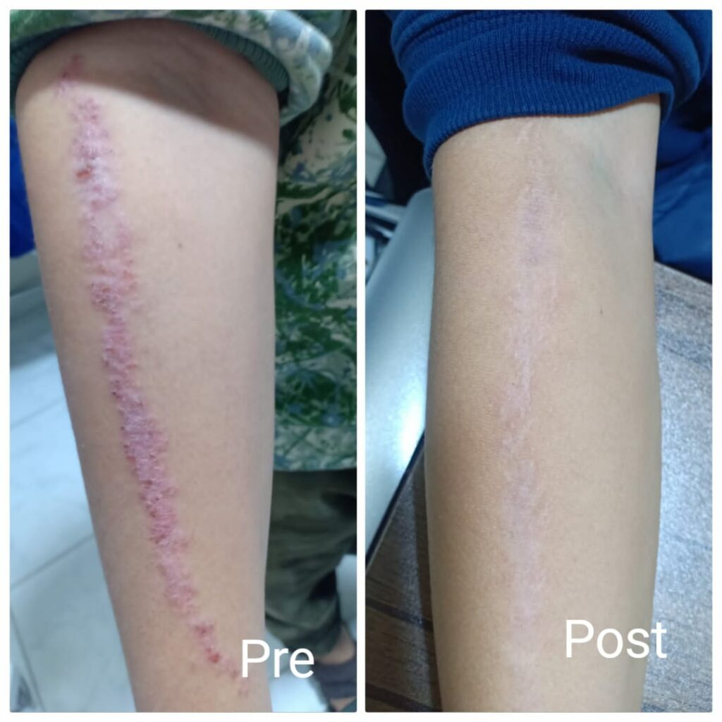 Lichen striatus treatment